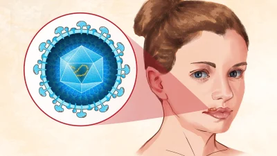 Герпес: ранние признаки, причины, лечение и естественные подходы