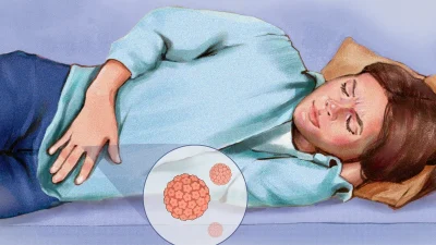 Рак шейки матки: симптомы, причины, лечение и естественные подходы