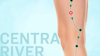 Акупунктура Хуань Тяо помогает тазобедренным суставам оставаться сильными