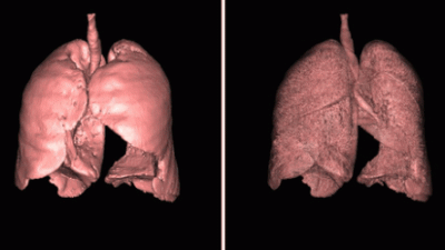 Как защитить лёгкие от горя: рецепт «нефритового экрана»