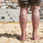 Эти два простых упражнения облегчают симптомы варикозного расширения вен