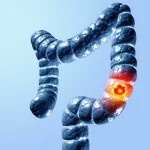 Почему скрининг не выявляет этот вид рака, от которого умирает больше молодых людей, чем от любого другого вида