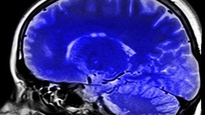 Снимок МРТ головного мозга в сагиттальной проекции для диагностики когнитивных нарушений и болезни Альцгеймера.