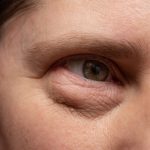 Как избавиться от мешков под глазами и предотвратить их появление