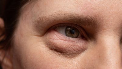 мешки под глазами