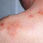 Когда стресс отражается на вашей коже: от внезапного выпадения волос до хронического воспаления