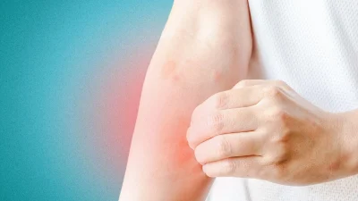 Человек чешет покрасневшую раздраженную кожу на руке, симптомы аллергической сыпи или дерматита.