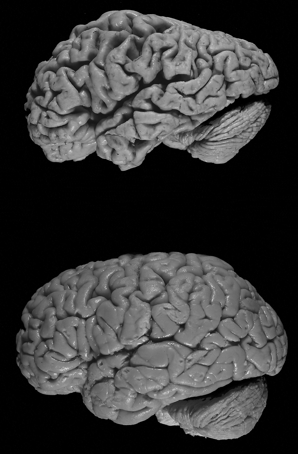 Brain diseases. Болезнь Альцгеймера мозг. Мозг больного Альцгеймером.