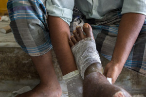 Индийская методика лечения переломов без обезболивания, рентгена и гипса