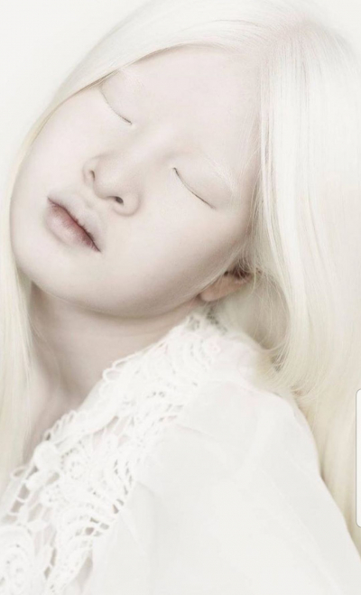 Брошенная родителями девочка-альбинос стала моделью